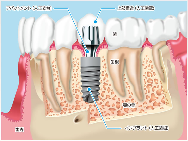 インプラントとは 佐々木歯科医院